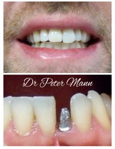 mini dental implant