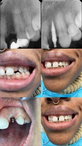 mini dental implant lateral incisor