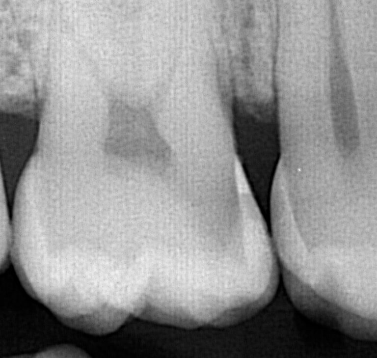 Deep tooth cavity