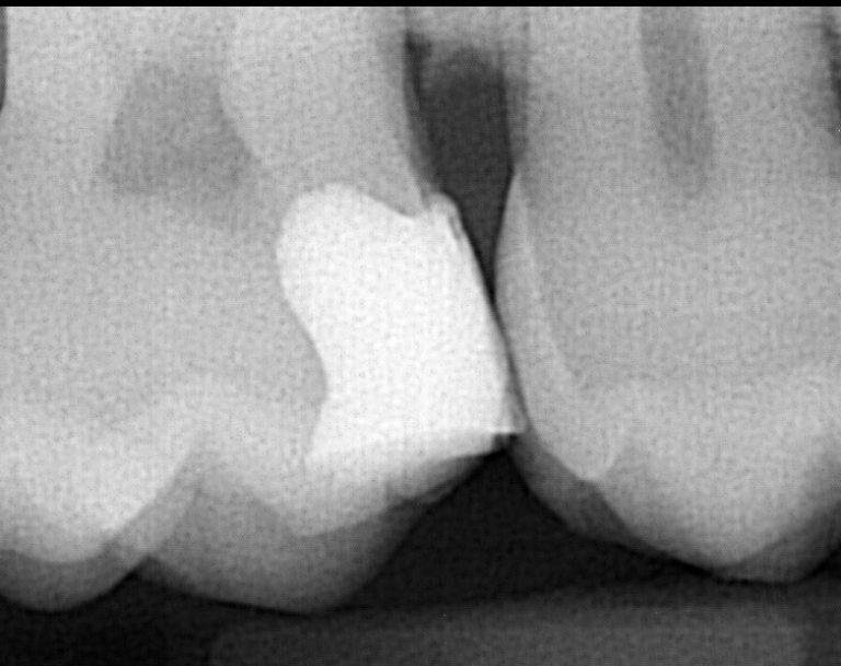 Deep Dental filling