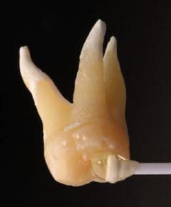upper wisdom tooth extraction
