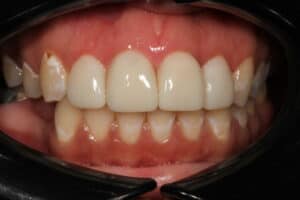 Four porcelain veneers on front teeth