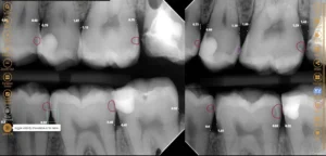 AI dental x-rays